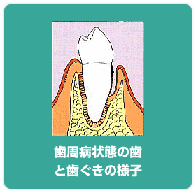 歯周病状態の歯と歯ぐきの様子
